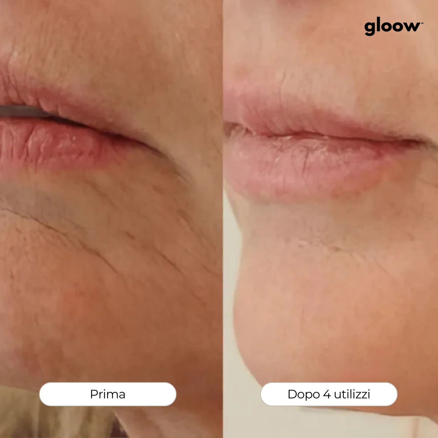Gloow Micro-Infusione Anti-Rughe | Peptidi + Collagene